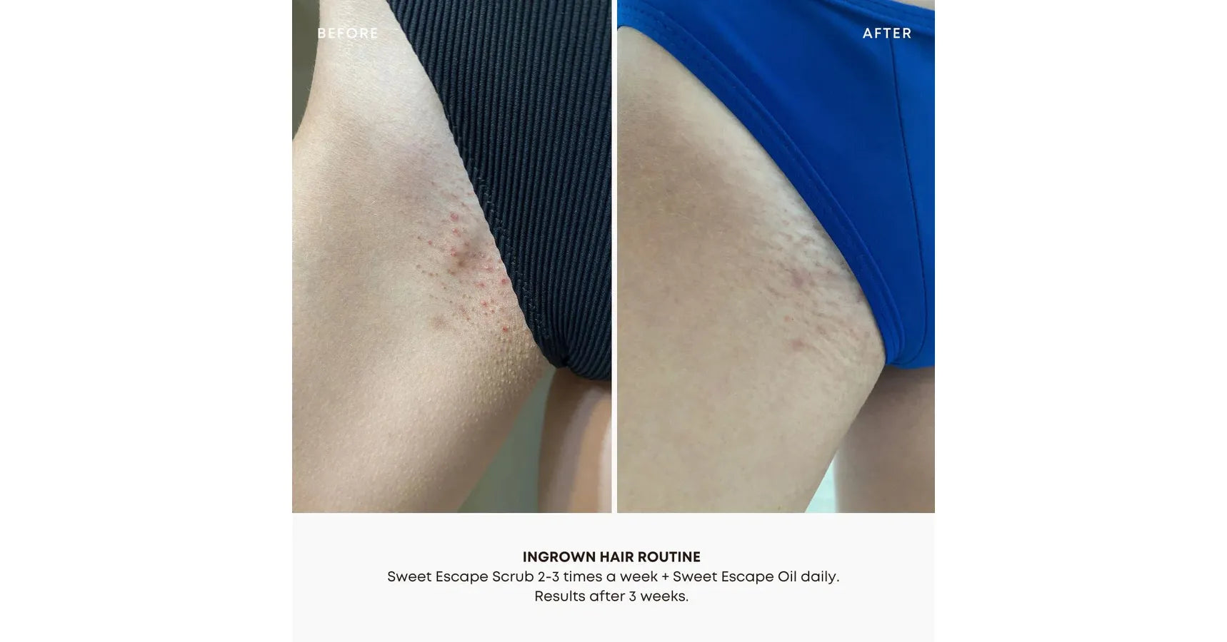 Bushbalm Sweet Escape Oil Ingrown Hair (30ml)