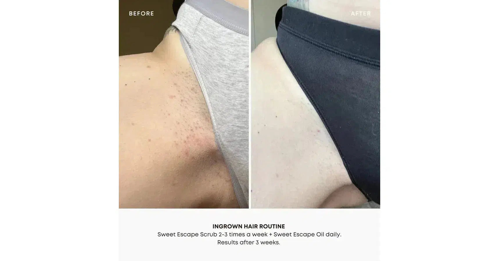 Bushbalm Sweet Escape Exfoliating Scrub Ingrown Hair (8oz/236ml)