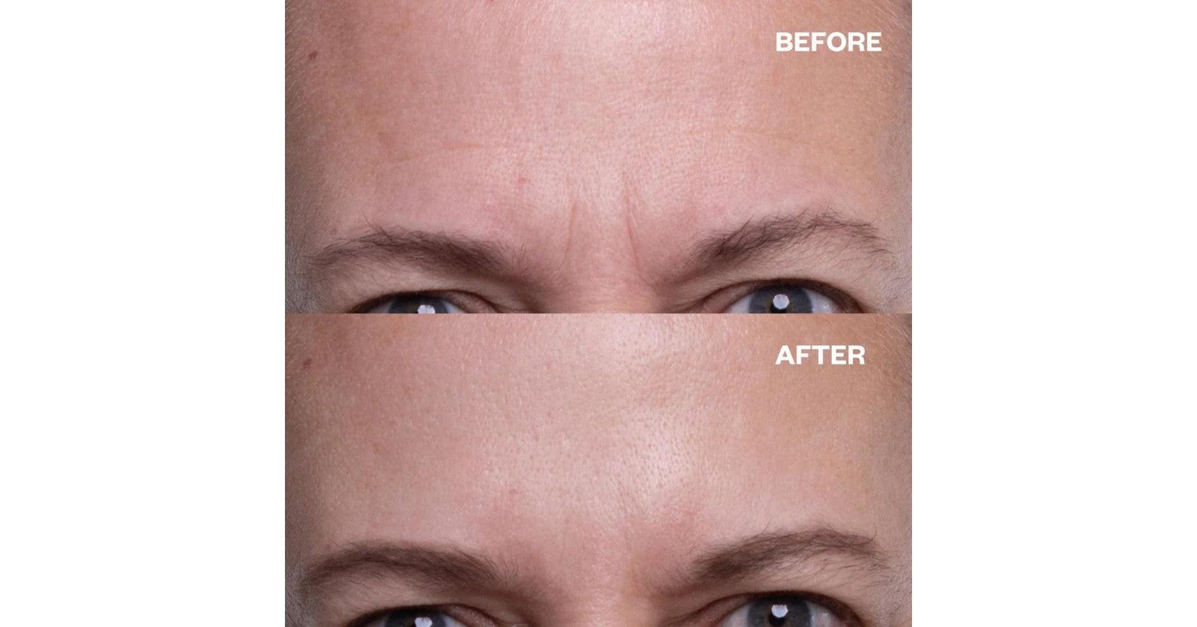 Wrinkles Schminkles Forehead Patches - reusable (2 per pack)