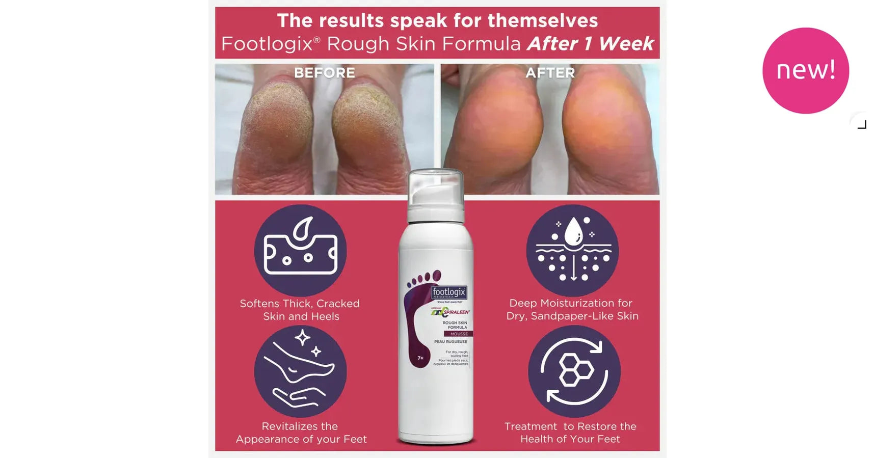 Footlogix Bye Bye Callus Kit