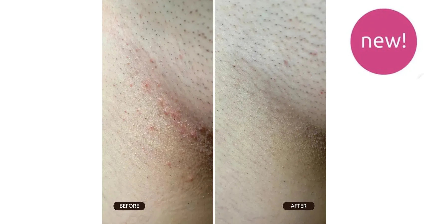 Bushbalm Berry Crush Exfoliating Scrub Ingrown Hair (8oz/236ml)